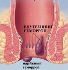 Лечение геморроя в клинике НЕО-МЕД Санкт-Петербруг